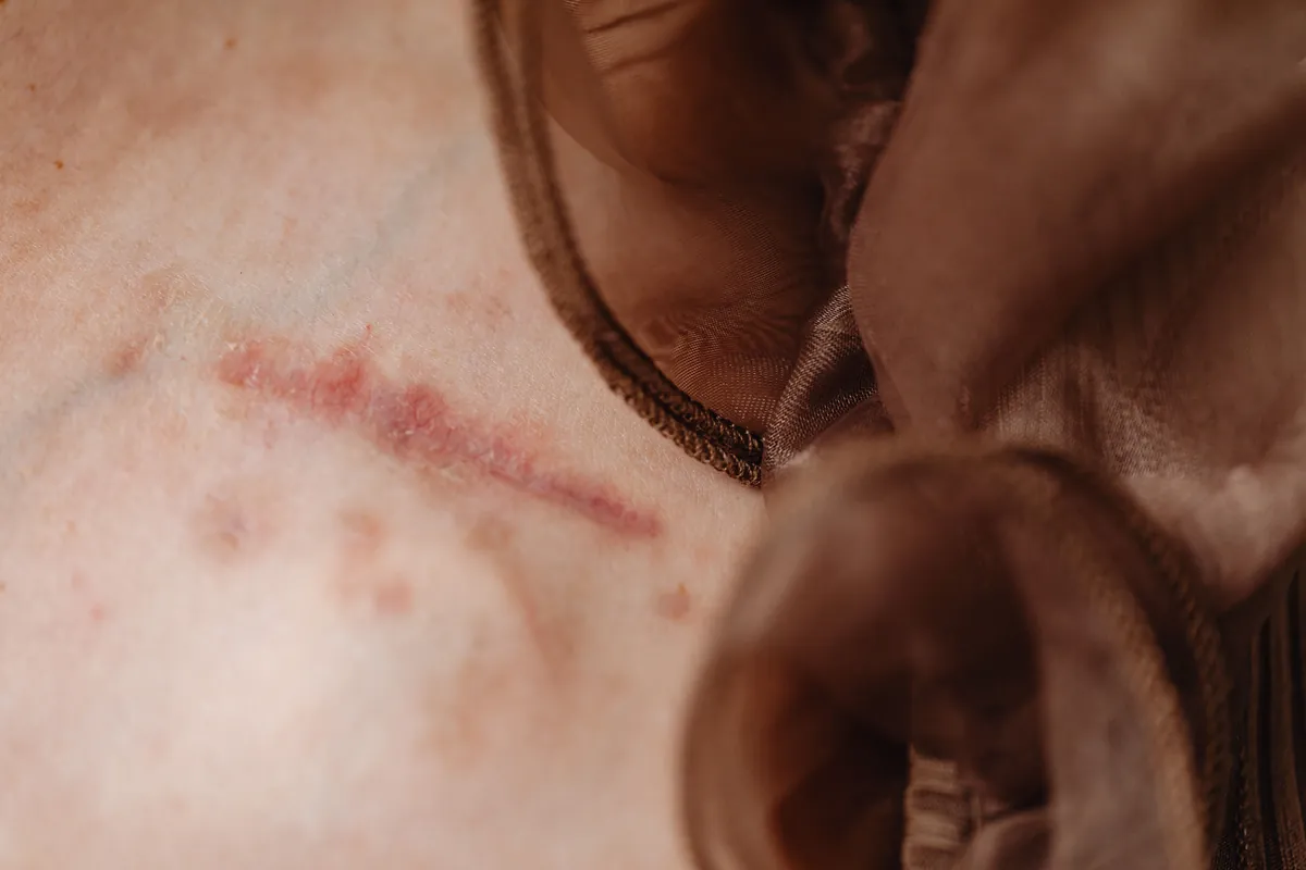 Phun xăm có để lại sẹo không