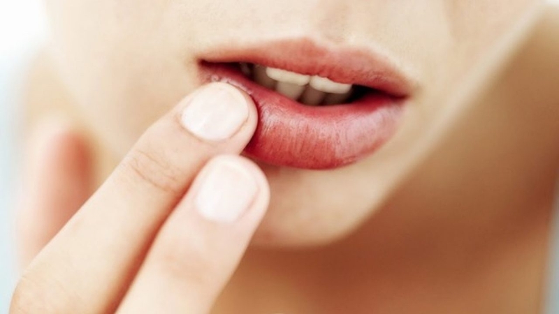 Phun môi dễ kích hoạt virus Herpes gây tình trạng sưng viêm