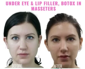 lip filler swelling recovery
