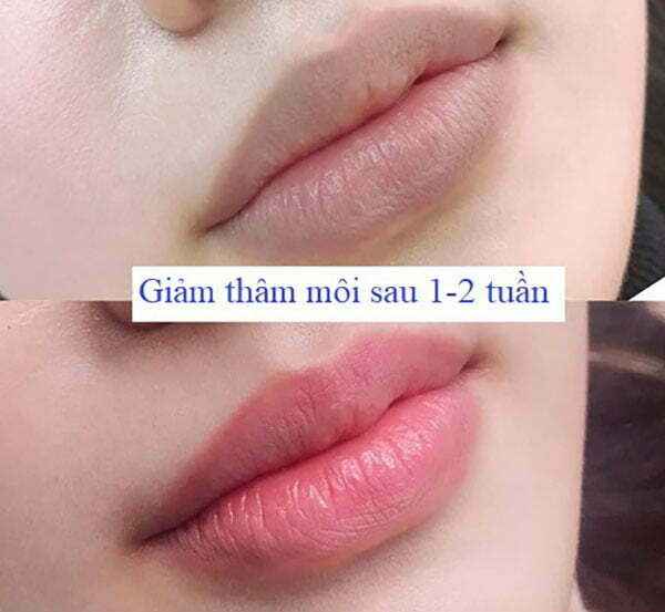 Khử thâm môi cần chờ một thời gian mới được phun màu