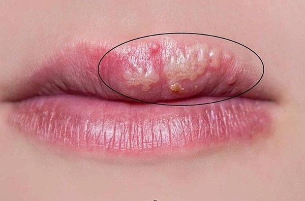 Chỉ nên bôi acyclovir ở những vị trí tổn thương trên môi