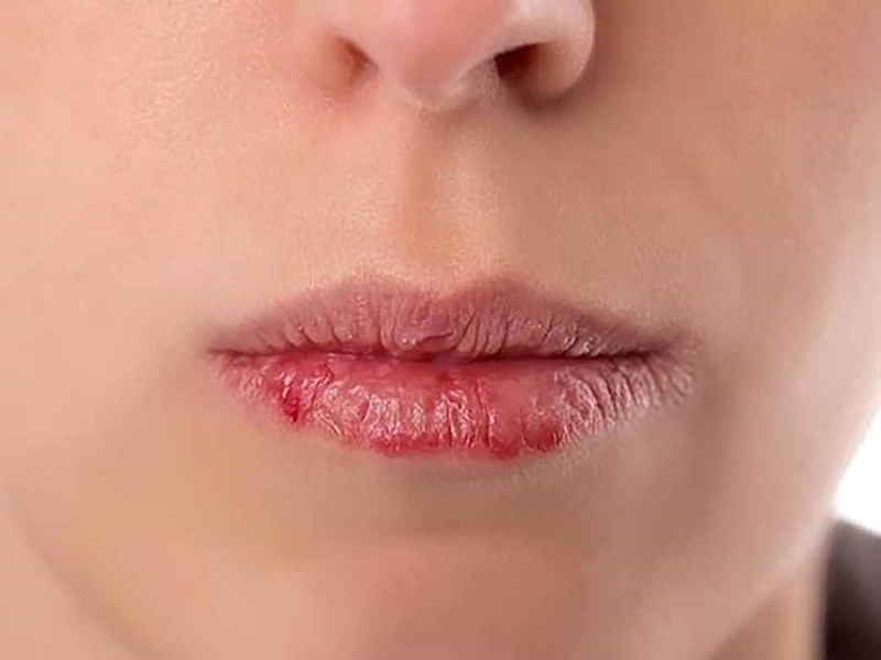 Phun môi bị sưng đau thường diễn ra từ 2-3 ngày sau phun