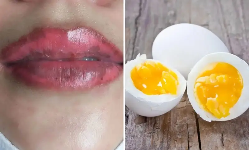 Lỡ ăn trứng sau phun môi thì cần theo dõi tình trạng để liên hệ bác sĩ kịp thời