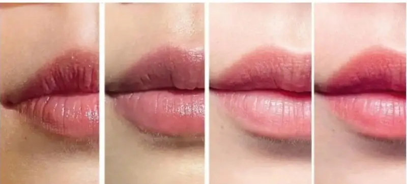 Quá trình hồi phục sau khử thâm môi trải qua nhiều giai đoạn