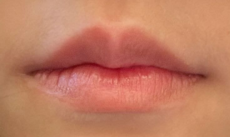 Môi nổi mụn nước là một trong những dấu hiệu phun môi bị nhiễm trùng