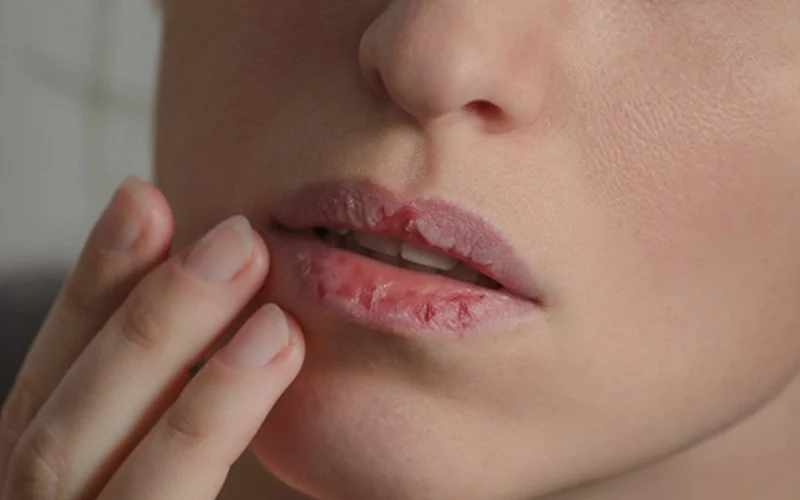 Cần liên hệ bác sĩ sớm nếu tình trạng phun môi bị nhiễm trùng kéo dài