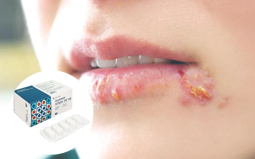 Không nên bôi acyclovir trong 24h đầu sau phun môi