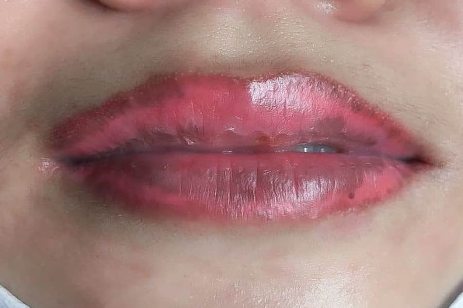 Những nguyên nhân phổ biến khiến mạch máu bị tổn thương và hình thành vết bầm tím dưới da môi