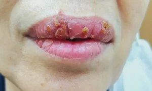 Dấu hiệu nhận biết tình trạng môi bị phồng rộp, nổi mụn nước li ti sau khi xăm