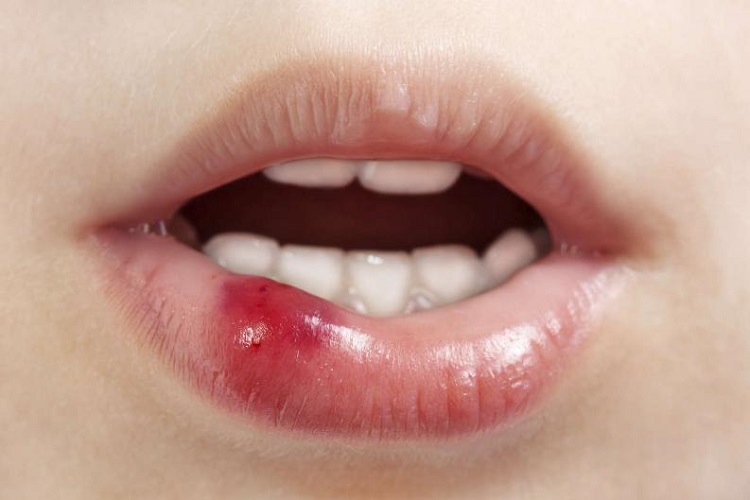 Cần nhanh chóng đến cơ sở y tế uy tín để được thăm khám và điều trị khi phát hiện môi có dấu hiệu bất thường