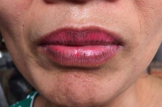 Giải đáp thắc mắc về tính an toàn của thuốc ủ tê trong phun xăm môi và cách phòng tránh các biến chứng