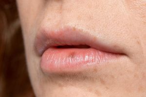 Chu trình chuyển màu và tiêu biến tự nhiên của vết máu bầm trên môi theo thời gian