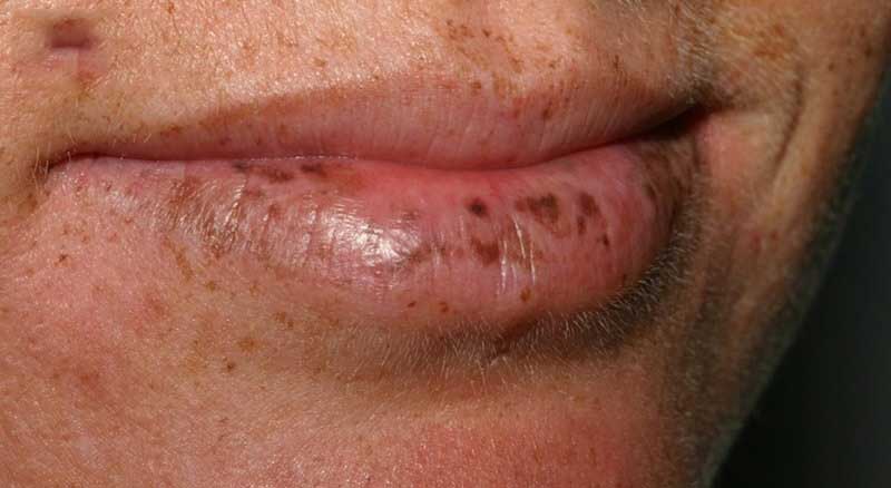 Phun môi bị đốm đen là tình trạng thường thấy sau phun môi