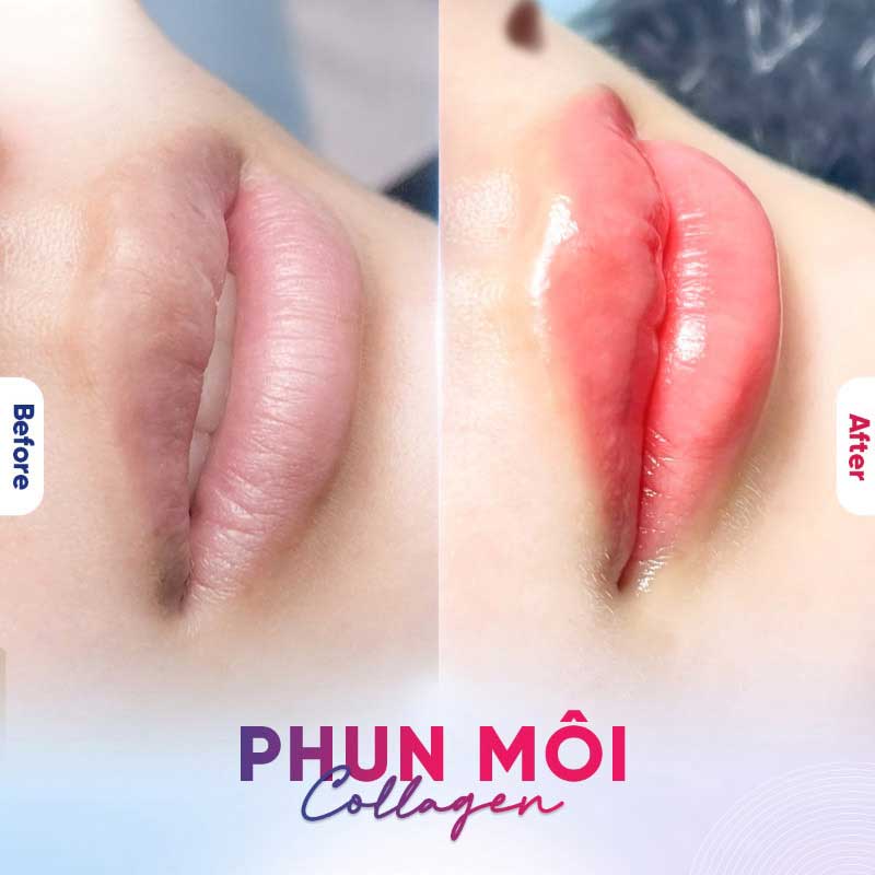 Phun môi collagen mang lại đôi môi căng mọng và tươi tắn