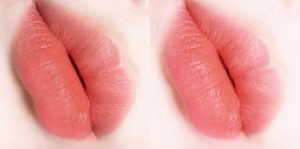 Kỹ thuật đi kim nano siêu vi giúp hạt mực cam sữa tệp mịn vào môi mà không gây tổn thương hay sưng đau
