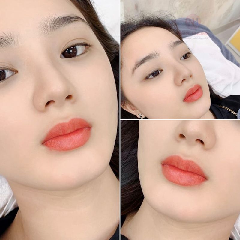 Sắc môi đỏ cam rạng rỡ, trong trẻo và mềm mịn sau khi lớp vảy non đã bong sạch hoàn toàn