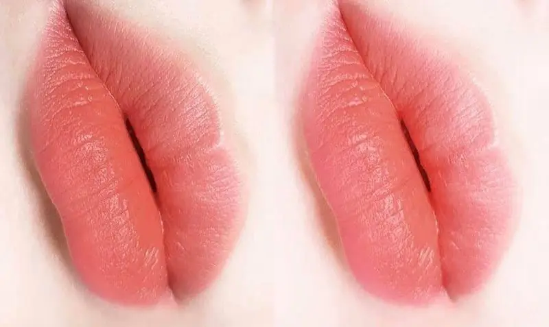 Kỹ thuật đi kim nano siêu vi rải hạt mực cam đất tầng nông êm ái, hạn chế tối đa tổn thương