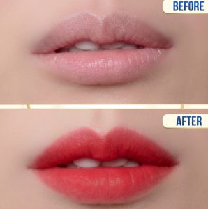 Phun môi nano hay collagen tốt hơn