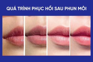 Quá trình hồi phục sau phun môi thường trải qua nhiều giai đoạn