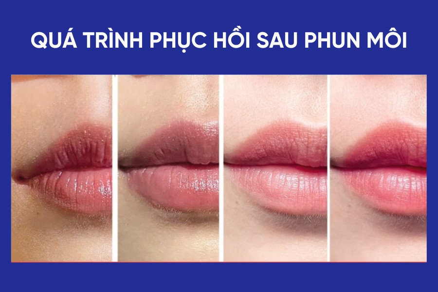 Quá trình hồi phục sau phun môi thường trải qua nhiều giai đoạn
