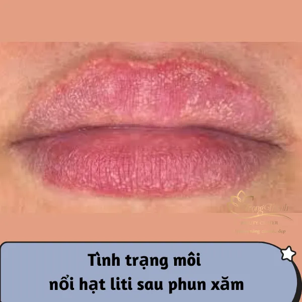 Môi phục hồi lành lặn, giữ trọn sắc màu tươi tắn sau khi được xử lý rộp môi kịp thời và đúng phác đồ
