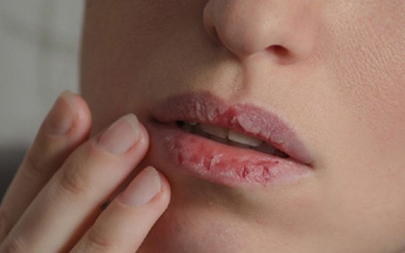 Vệ sinh bằng nước muối sinh lý và thoa thuốc đặc trị đúng cách giúp nốt rộp nhanh se cồi và lành miệng