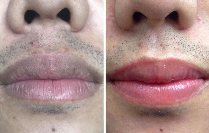 Khắc phục triệt để tình trạng môi thâm xỉn lâu năm ở phái mạnh chỉ sau một liệu trình khử thâm chuyên sâu
